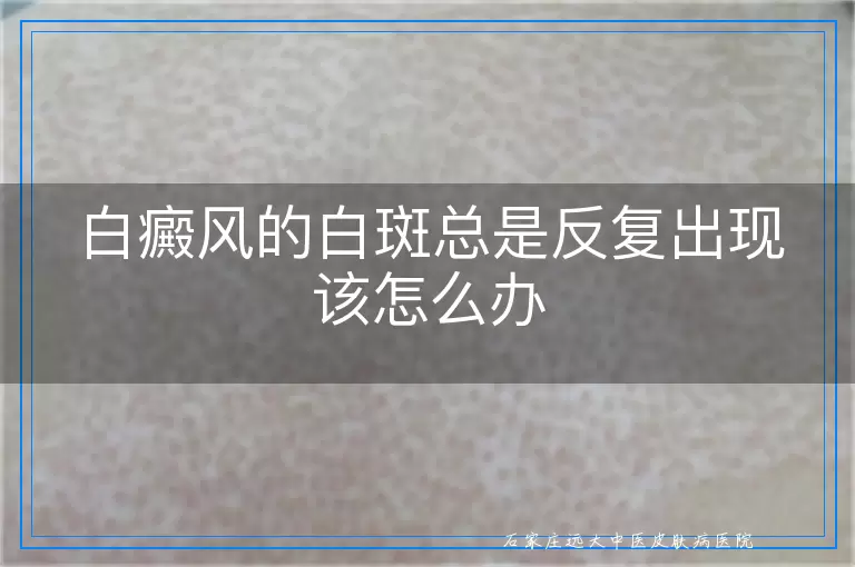白癜风的白斑总是反复出现该怎么办
