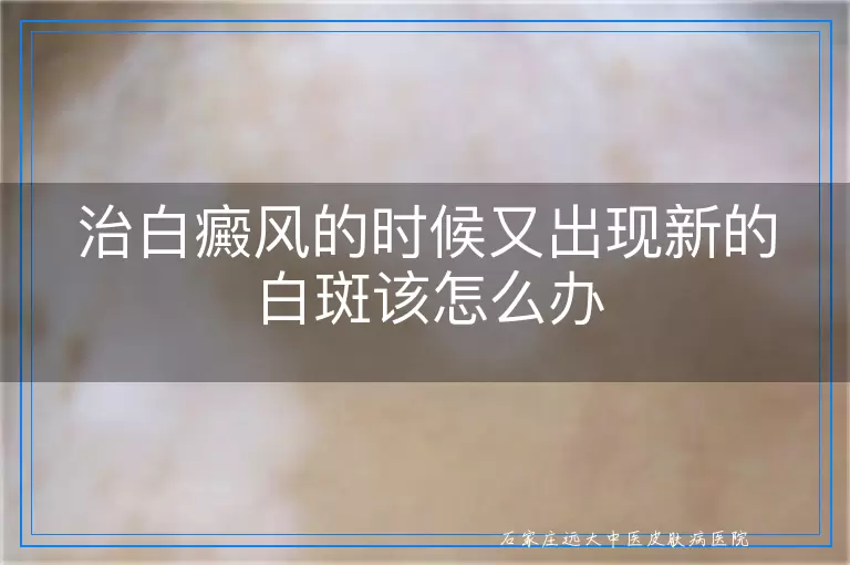 治白癜风的时候又出现新的白斑该怎么办