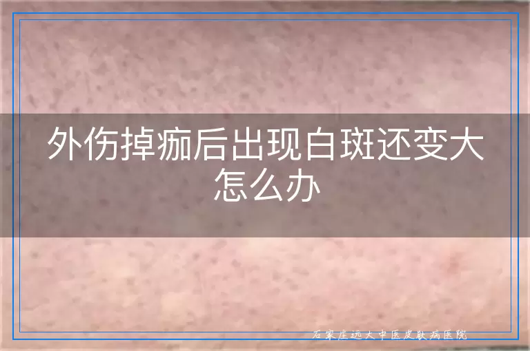 外伤掉痂后出现白斑还变大怎么办