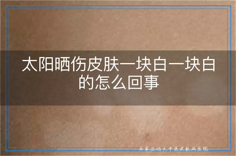 太阳晒伤皮肤一块白一块白的怎么回事