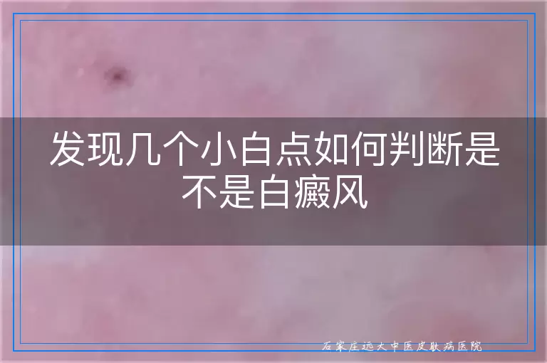 发现几个小白点如何判断是不是白癜风