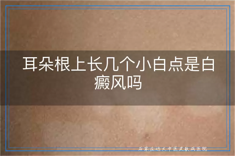 耳朵根上长几个小白点是白癜风吗