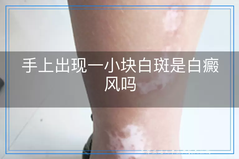 手上出现一小块白斑是白癜风吗