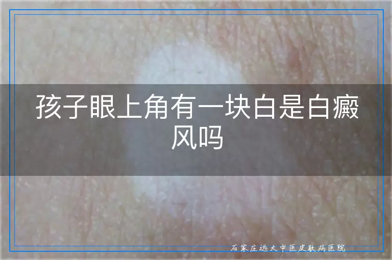 孩子眼上角有一块白是白癜风吗