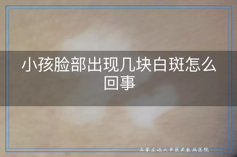 小孩脸部出现几块白斑怎么回事