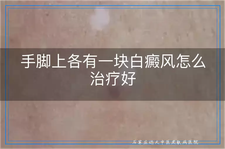 手脚上各有一块白癜风怎么治疗好