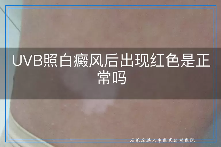 UVB照白癜风后出现红色是正常吗