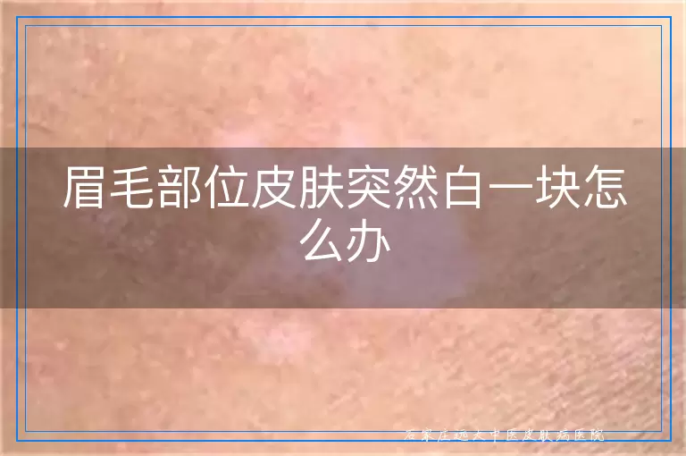 眉毛部位皮肤突然白一块怎么办