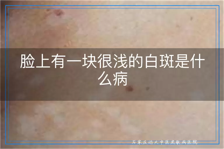 脸上有一块很浅的白斑是什么病
