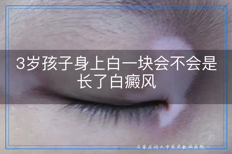 3岁孩子身上白一块会不会是长了白癜风
