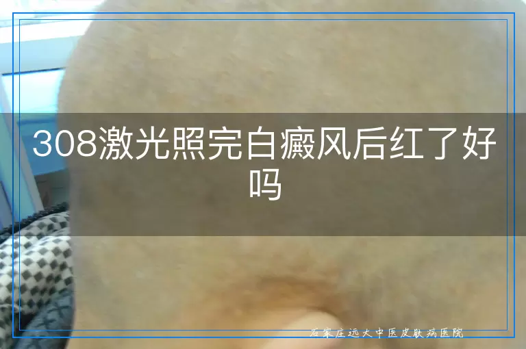 308激光照完白癜风后红了好吗