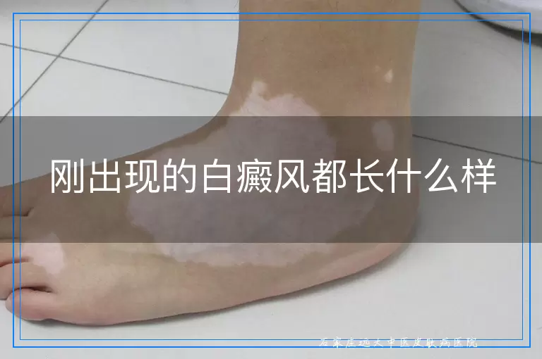 刚出现的白癜风都长什么样