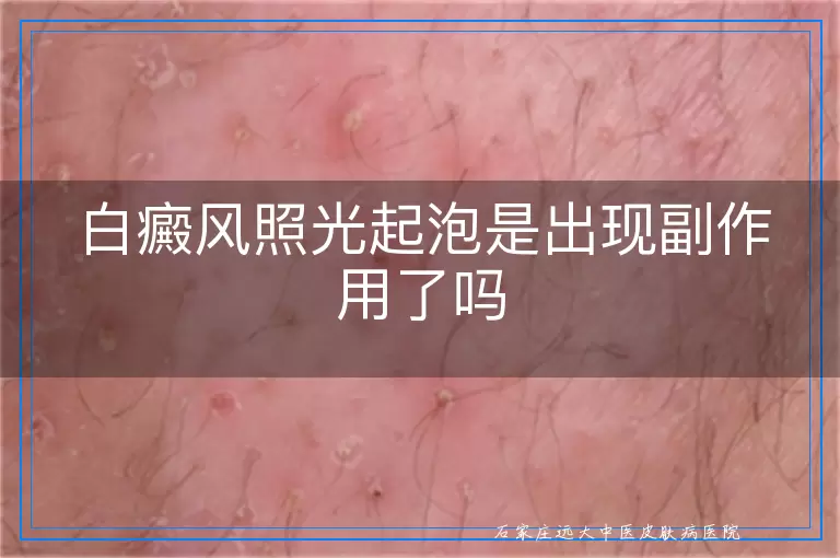 白癜风照光起泡是出现副作用了吗
