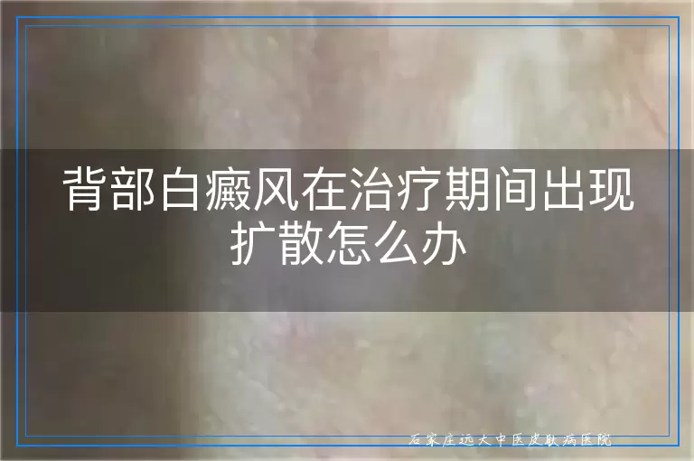 背部白癜风在治疗期间出现扩散怎么办