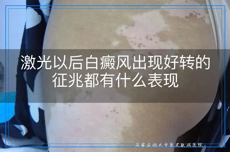 激光以后白癜风出现好转的征兆都有什么表现