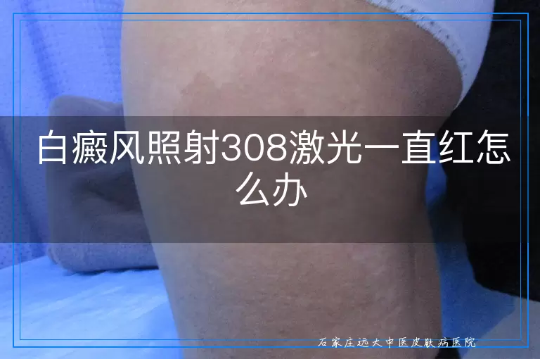 白癜风照射308激光一直红怎么办