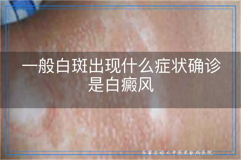 一般白斑出现什么症状确诊是白癜风