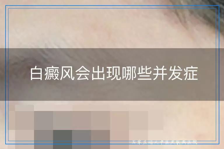 白癜风会出现哪些并发症