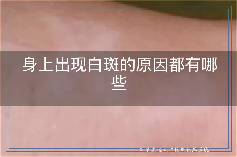 身上出现白斑的原因都有哪些