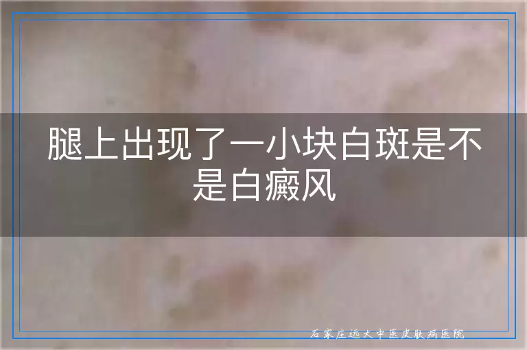 腿上出现了一小块白斑是不是白癜风