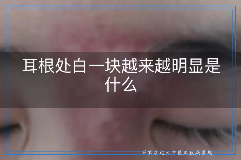 耳根处白一块越来越明显是什么