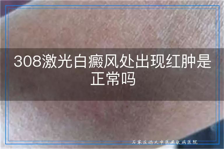 308激光白癜风处出现红肿是正常吗