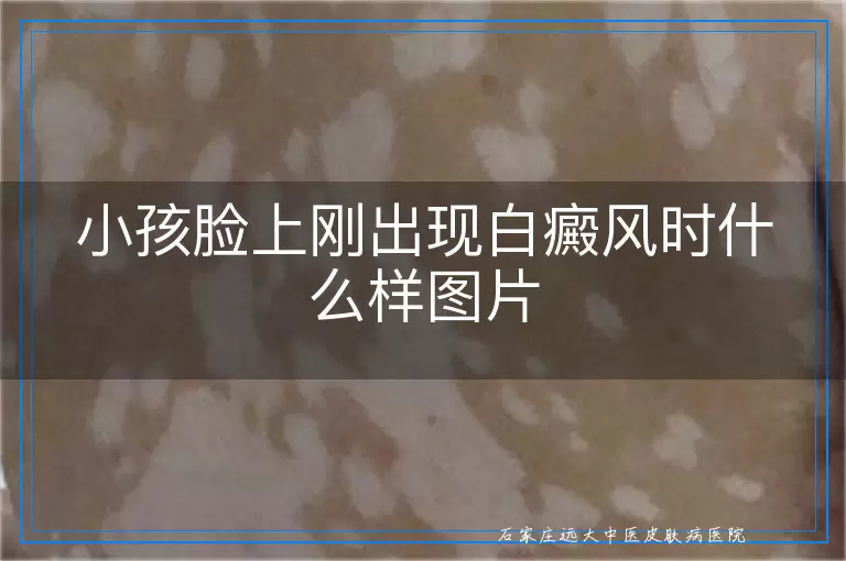 小孩脸上刚出现白癜风时什么样图片