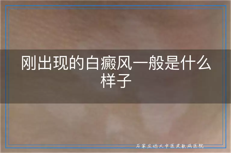 刚出现的白癜风一般是什么样子