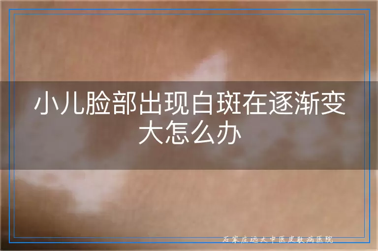 小儿脸部出现白斑在逐渐变大怎么办