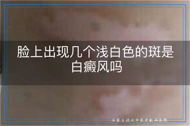脸上出现几个浅白色的斑是白癜风吗