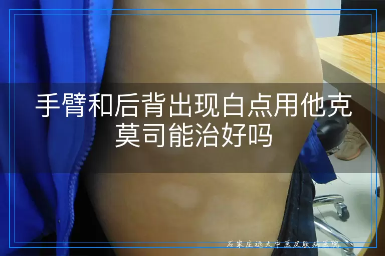手臂和后背出现白点用他克莫司能治好吗