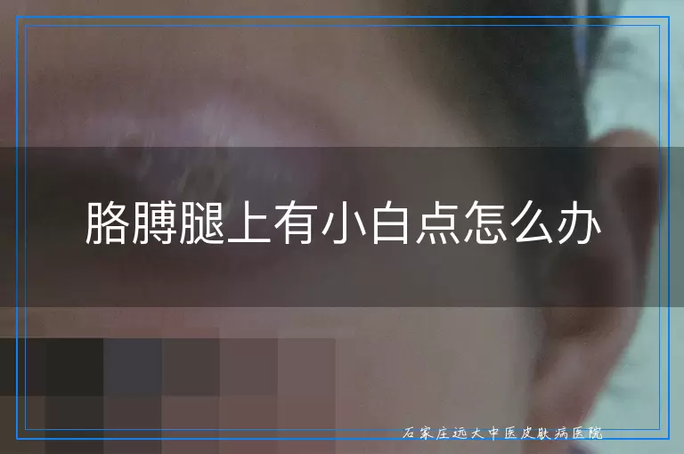 胳膊腿上有小白点怎么办
