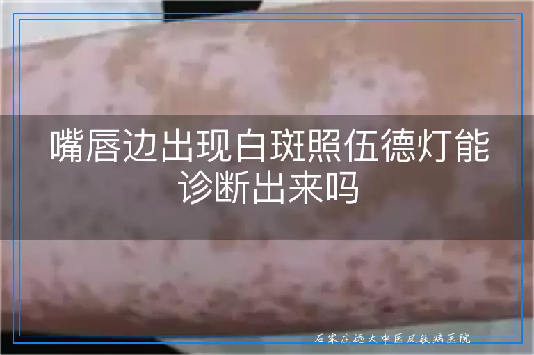 嘴唇边出现白斑照伍德灯能诊断出来吗