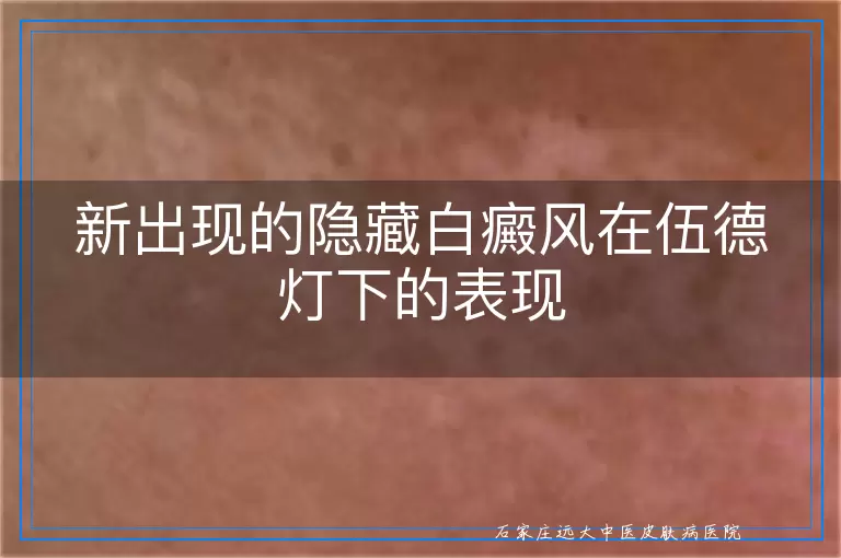 新出现的隐藏白癜风在伍德灯下的表现