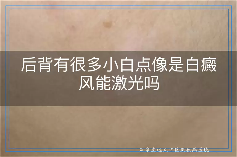 后背有很多小白点像是白癜风能激光吗