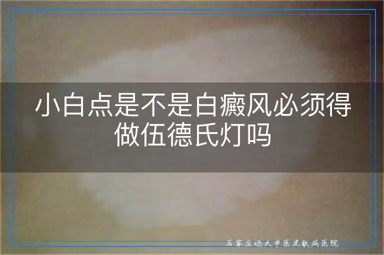 小白点是不是白癜风必须得做伍德氏灯吗