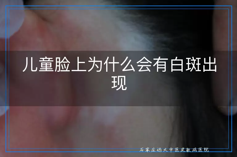 儿童脸上为什么会有白斑出现