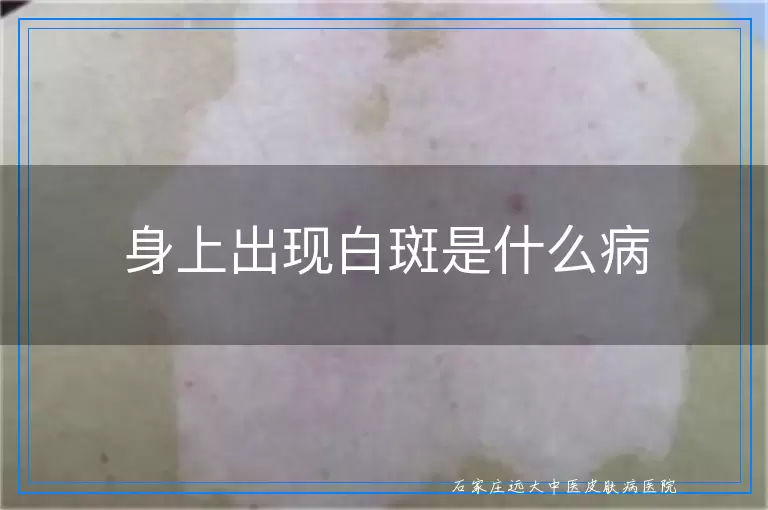 身上出现白斑是什么病