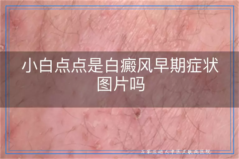 小白点点是白癜风早期症状图片吗