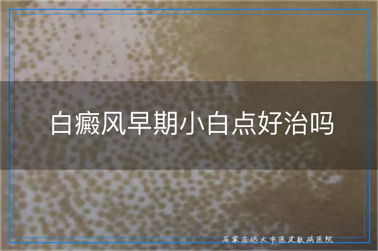 白癜风早期小白点好治吗