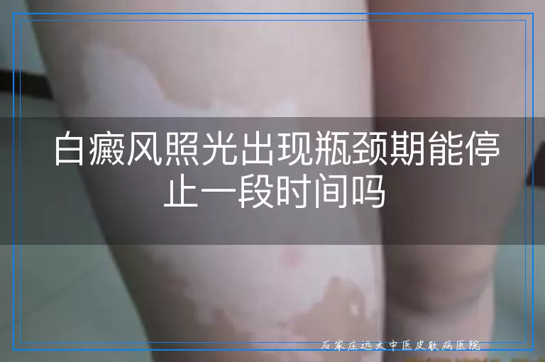 白癜风照光出现瓶颈期能停止一段时间吗