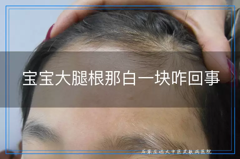 宝宝大腿根那白一块咋回事