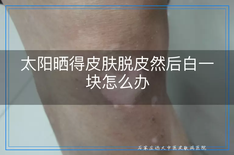 太阳晒得皮肤脱皮然后白一块怎么办