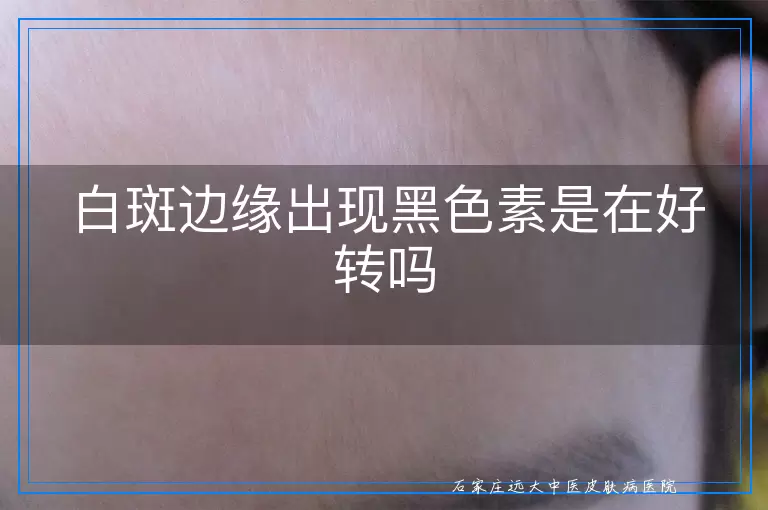 白斑边缘出现黑色素是在好转吗