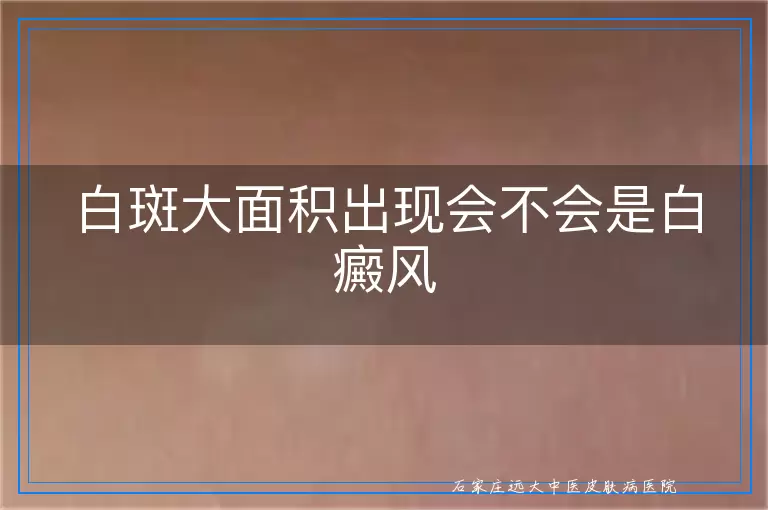 白斑大面积出现会不会是白癜风