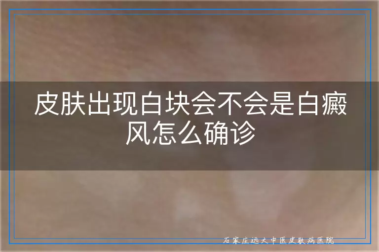 皮肤出现白块会不会是白癜风怎么确诊