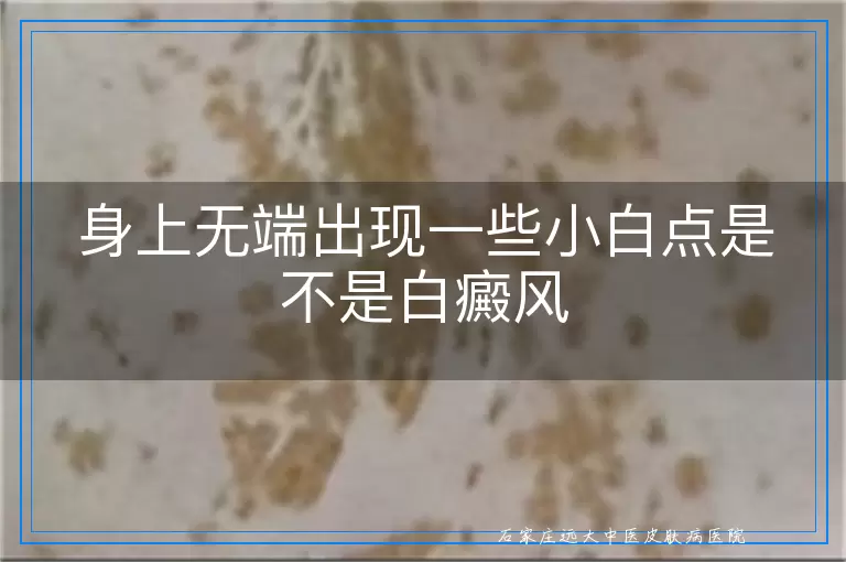 身上无端出现一些小白点是不是白癜风