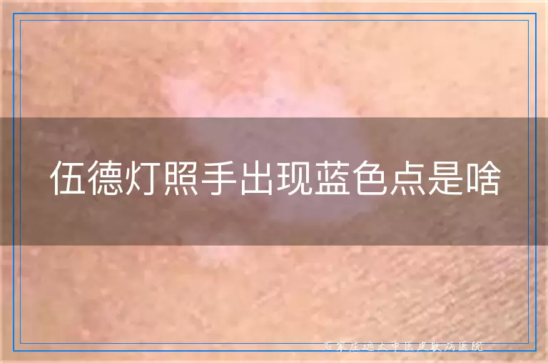 伍德灯照手出现蓝色点是啥