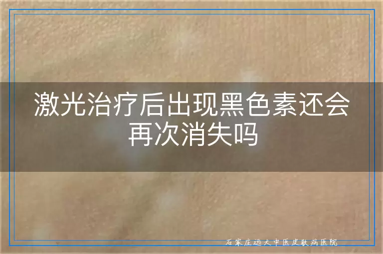 激光治疗后出现黑色素还会再次消失吗