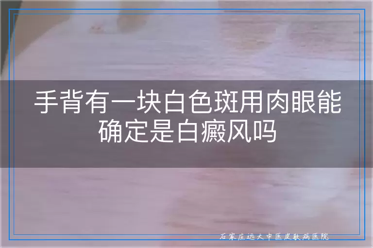 手背有一块白色斑用肉眼能确定是白癜风吗